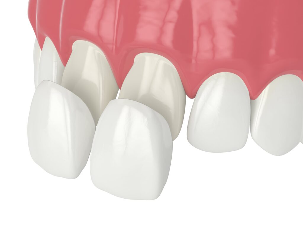 Dental Veneers in Edmonton